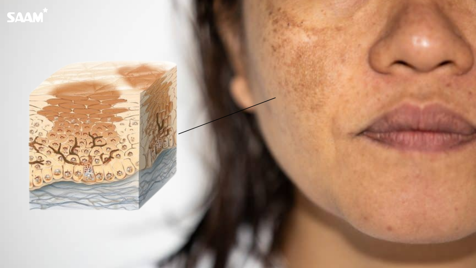 Hyperpigmentation is unlikely to fade on its own and requires specialized treatment to prevent recurrence