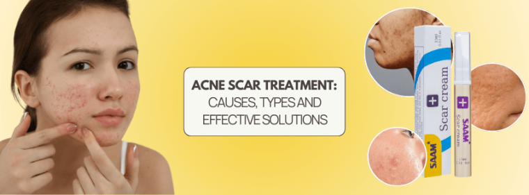 Woman with acne scars applying treatment – SAAM scar cream